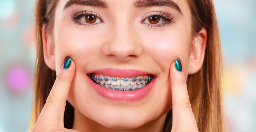 Braces The Good and the Bad Explained