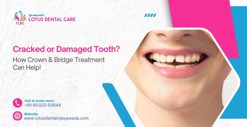 Cracked or Damaged Tooth How Crown Bridge Treatment Can Help