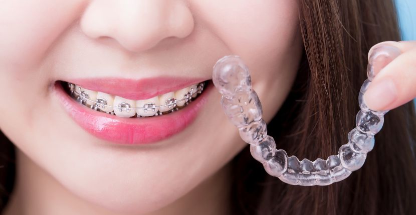 Dental Braces Treatment and Options