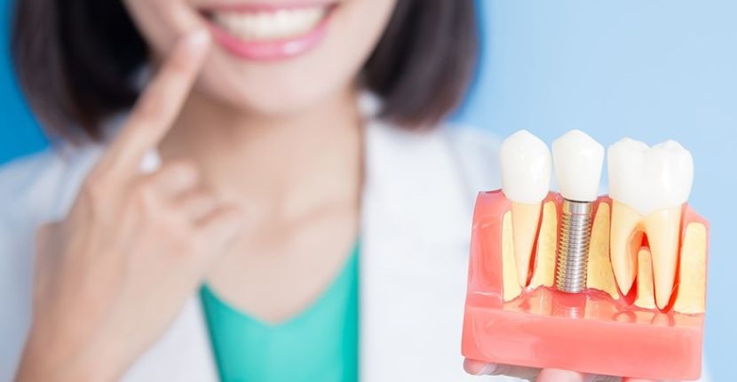 Dental Implant Components Demystified Posts Abutments and Crowns