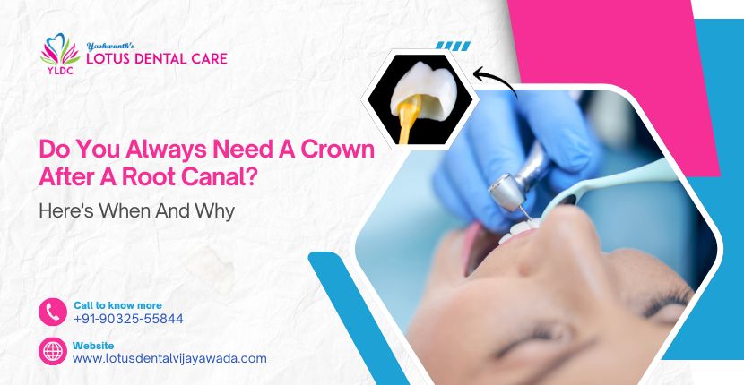 Do You Always Need a Crown After a Root Canal Heres When and Why