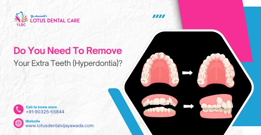 Do You Need to Remove Your Extra Teeth (Hyperdontia)?