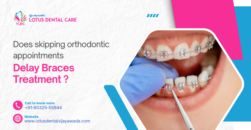 Does Skipping Orthodontic Appointments Delay Braces Treatment?