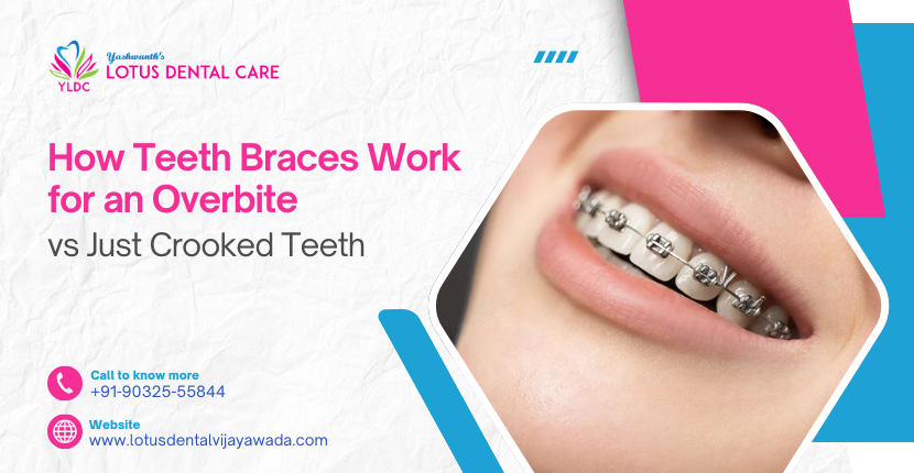 How Teeth Braces Work for Overbite vs Crooked Teeth