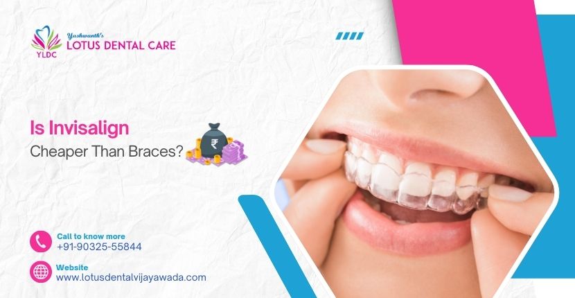 Is Invisalign Cheaper Than Braces?