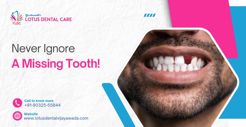 Never Ignore a Missing Tooth