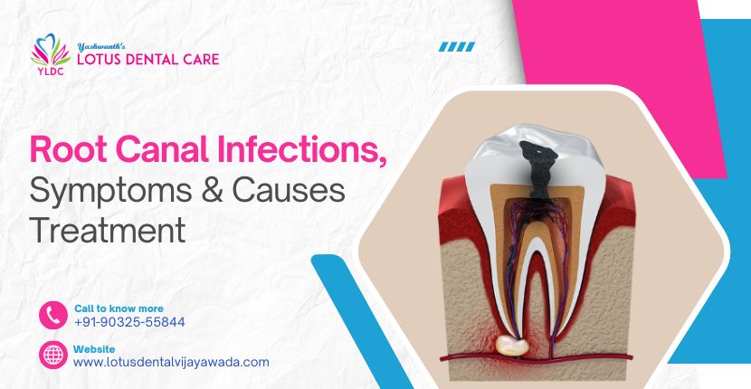 Root Canal Infections Symptoms Causes And Treatment
