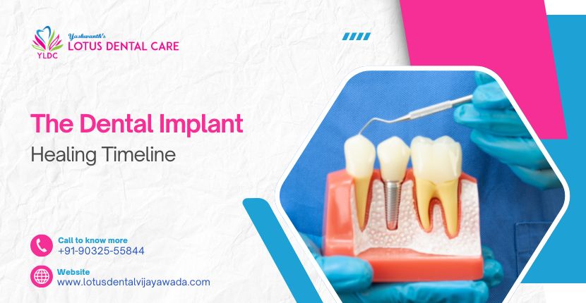 The Dental Implant Healing Timeline‍