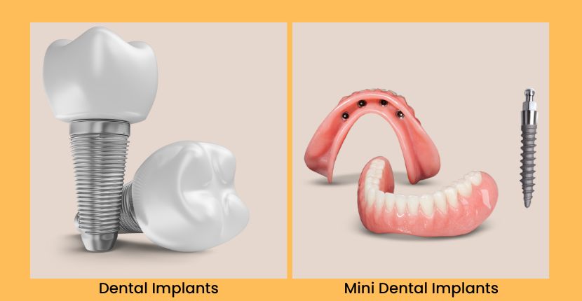 The Difference Between Dental Implants and Mini Dental Implants