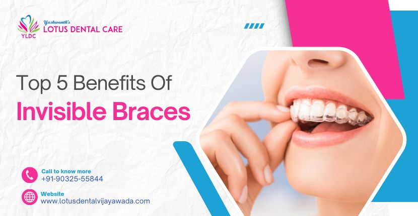 Top 5 Benefits Of Invisible Braces