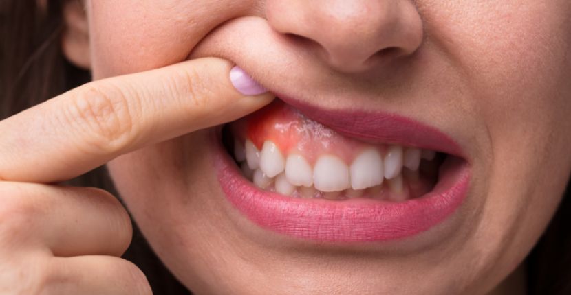 Top Benefits of Laser Gum Surgery