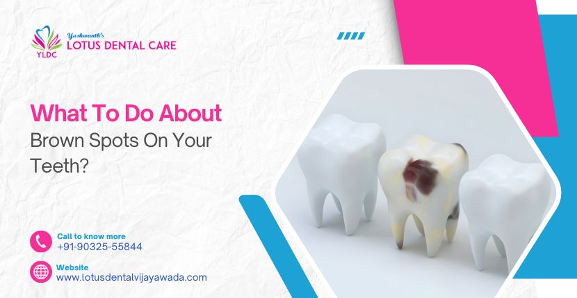 What To Do About Brown Spots On Your Teeth?